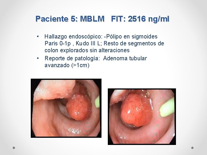 Paciente 5: MBLM FIT: 2516 ng/ml • Hallazgo endoscópico: -Pólipo en sigmoides Paris 0