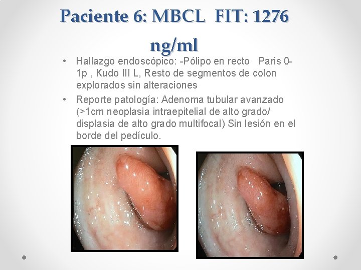 Paciente 6: MBCL FIT: 1276 ng/ml • Hallazgo endoscópico: -Pólipo en recto Paris 01