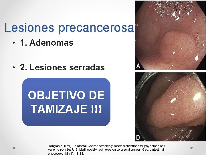 Lesiones precancerosas • 1. Adenomas • 2. Lesiones serradas OBJETIVO DE TAMIZAJE !!! Douglas