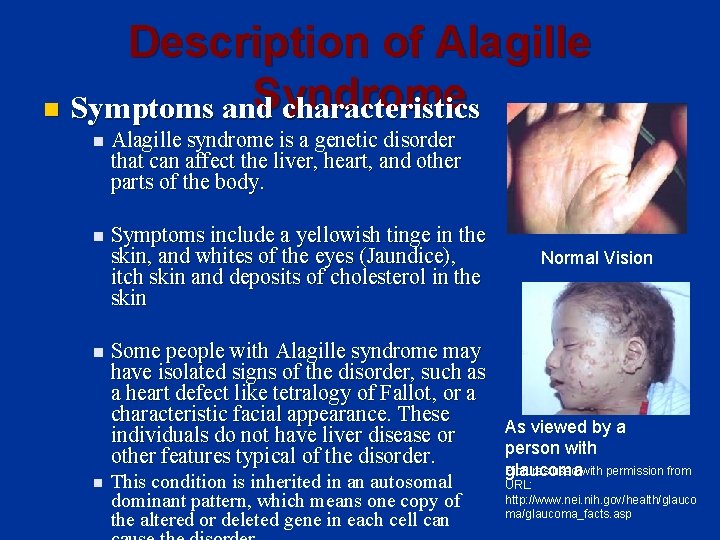 Description of Alagille Syndrome n Symptoms and characteristics n Alagille syndrome is a genetic Description of Alagille Syndrome n Symptoms and characteristics n Alagille syndrome is a genetic