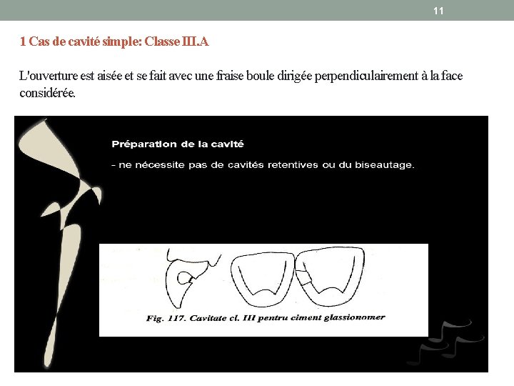 11 1 Cas de cavité simple: Classe III. A L'ouverture est aisée et se