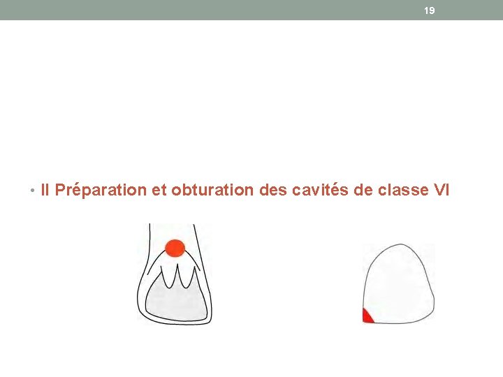 19 • II Préparation et obturation des cavités de classe VI 