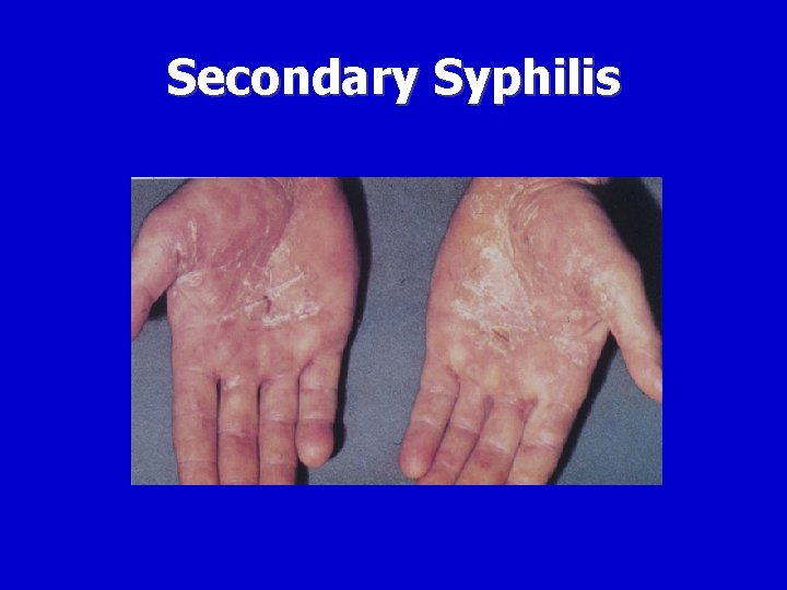 Secondary Syphilis 