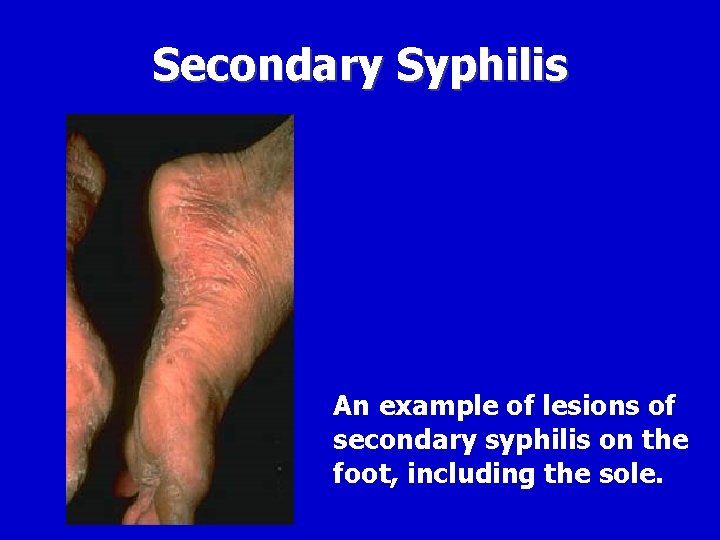 Secondary Syphilis An example of lesions of secondary syphilis on the foot, including the