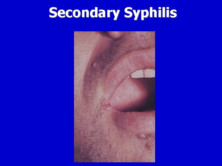 Secondary Syphilis 