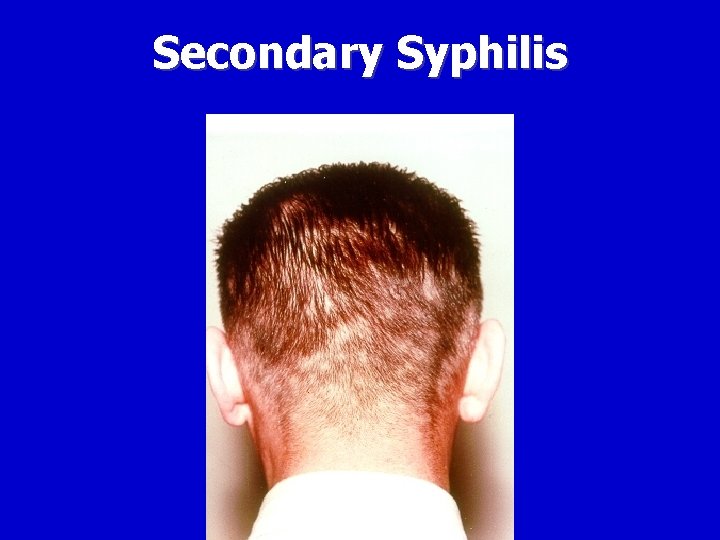 Secondary Syphilis 