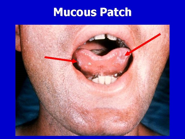 Mucous Patch 