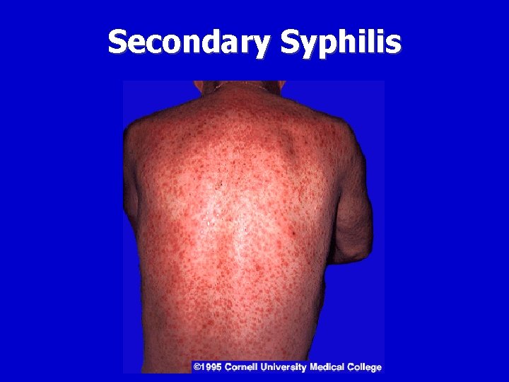 Secondary Syphilis 