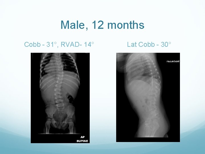 Male, 12 months Cobb - 31°, RVAD- 14° Lat Cobb - 30° 