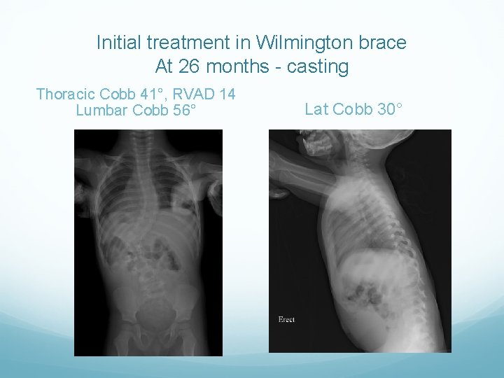 Initial treatment in Wilmington brace At 26 months - casting Thoracic Cobb 41°, RVAD