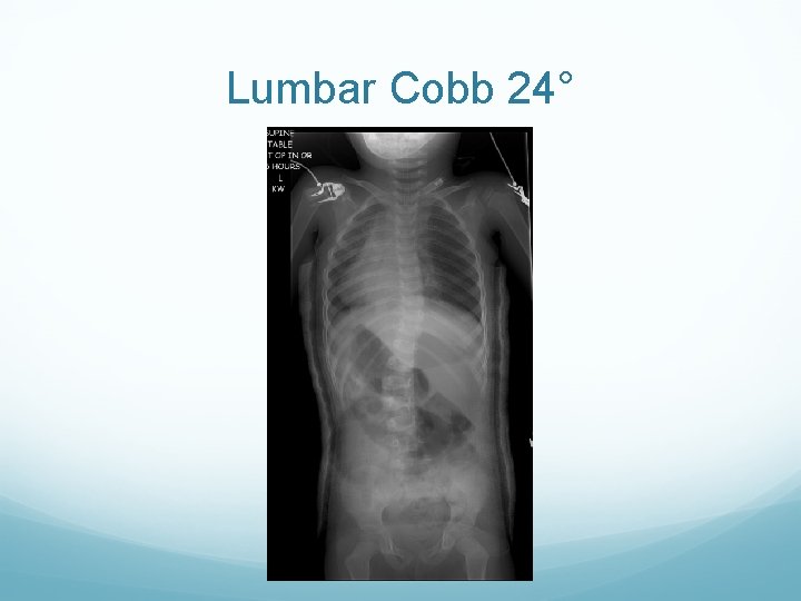 Lumbar Cobb 24° 