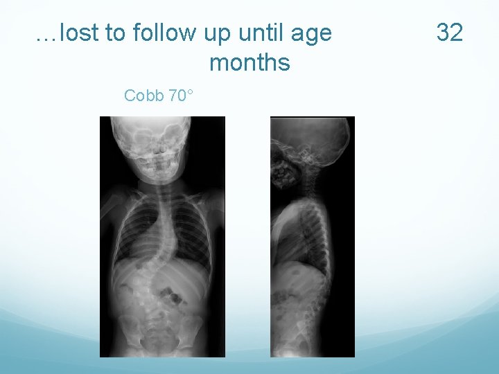 …lost to follow up until age months Cobb 70° 32 