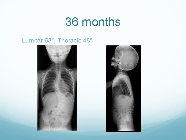 36 months Lumbar 68°, Thoracic 48° 