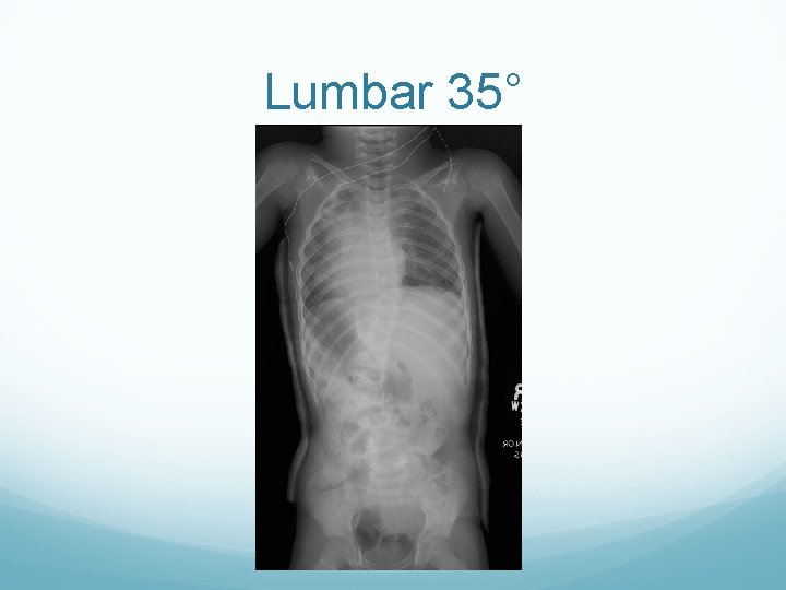 Lumbar 35° 