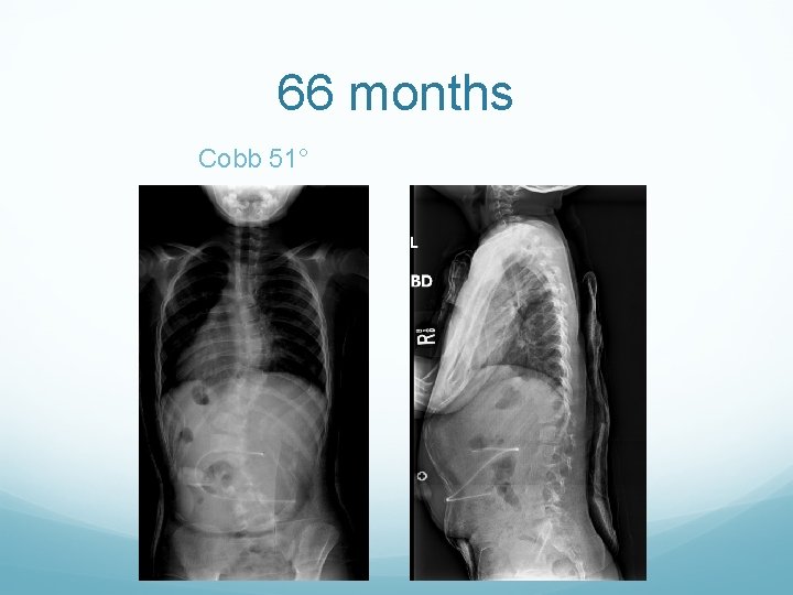 66 months Cobb 51° 