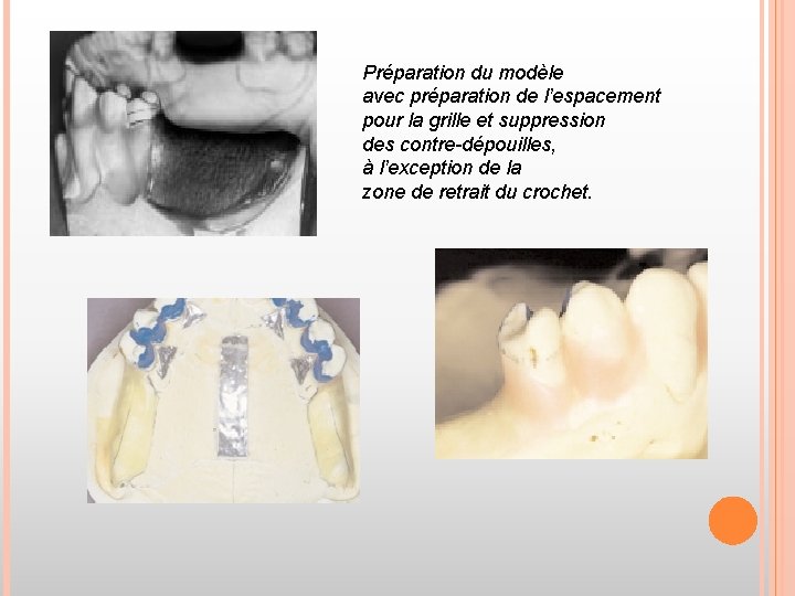 Préparation du modèle avec préparation de l’espacement pour la grille et suppression des contre-dépouilles,