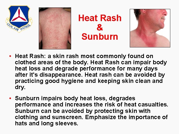 Heat Rash & Sunburn • Heat Rash: a skin rash most commonly found on