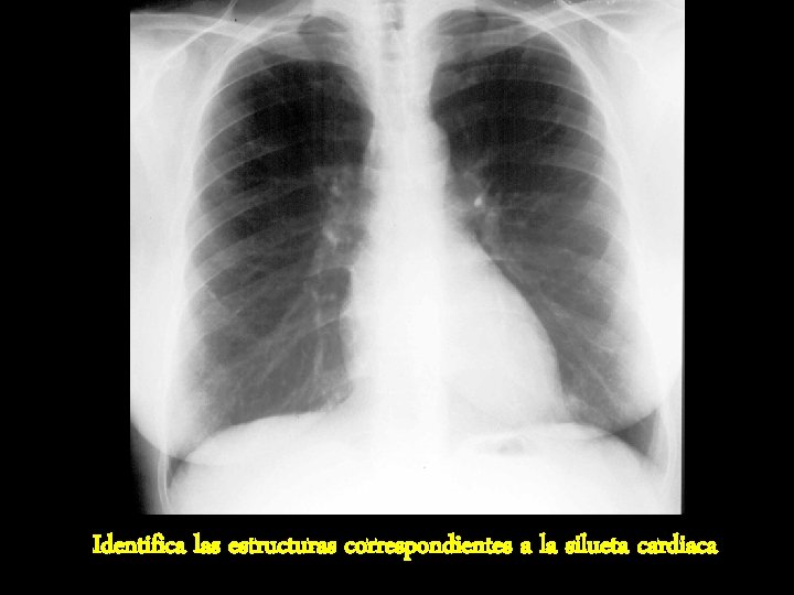 Identifica las estructuras correspondientes a la silueta cardiaca Identifica las estructuras correspondientes a la silueta cardiaca