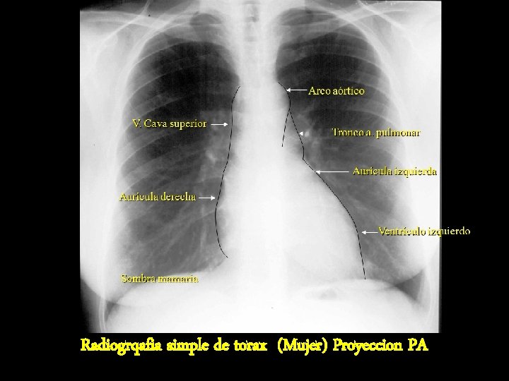 Radiogrqafia simple de torax (Mujer) Proyeccion PA Radiogrqafia simple de torax (Mujer) Proyeccion PA