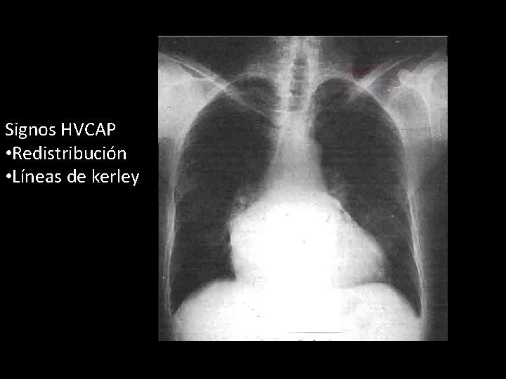 Signos HVCAP • Redistribución • Líneas de kerley Signos HVCAP • Redistribución • Líneas de kerley