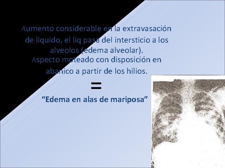 Aumento considerable en la extravasación de liquido, el liq pasa del intersticio a los Aumento considerable en la extravasación de liquido, el liq pasa del intersticio a los