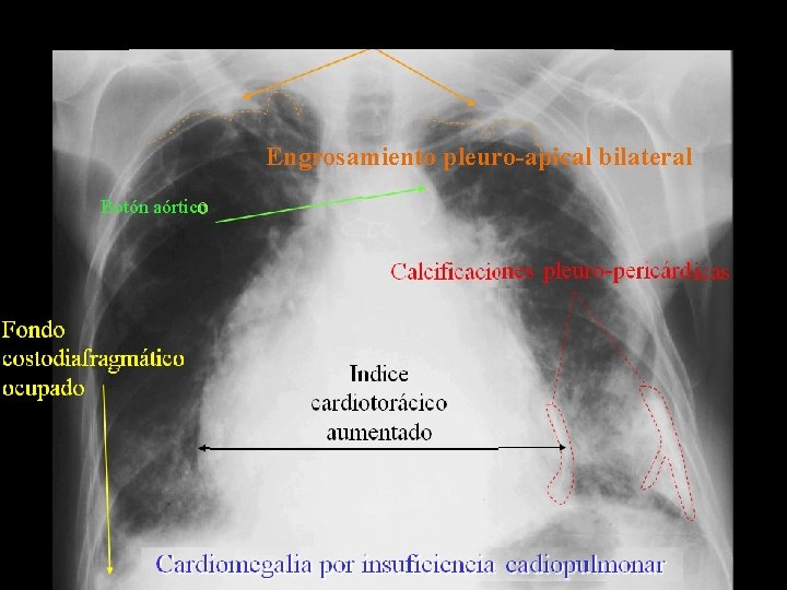 Engrosamiento pleuro-apical bilateral Botón aórtico Engrosamiento pleuro-apical bilateral Botón aórtico