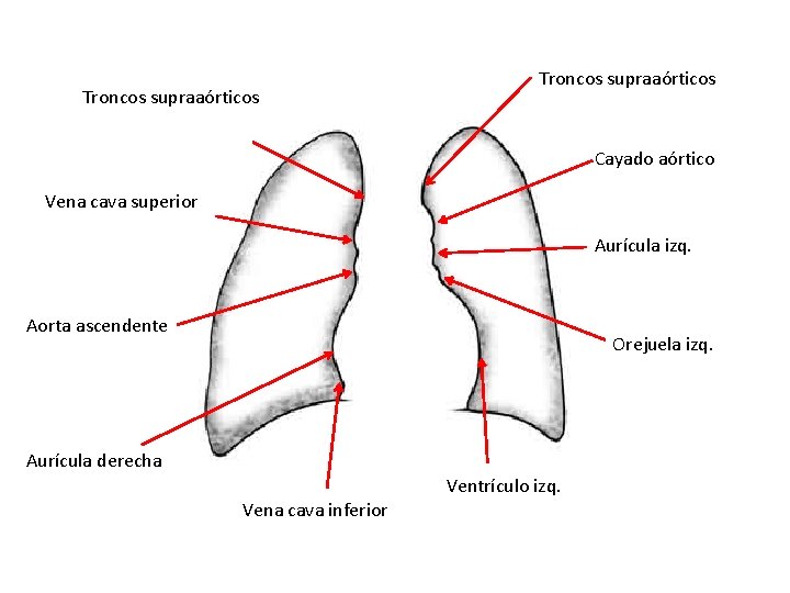 Troncos supraaórticos Cayado aórtico Vena cava superior Aurícula izq. Aorta ascendente Orejuela izq. Aurícula Troncos supraaórticos Cayado aórtico Vena cava superior Aurícula izq. Aorta ascendente Orejuela izq. Aurícula