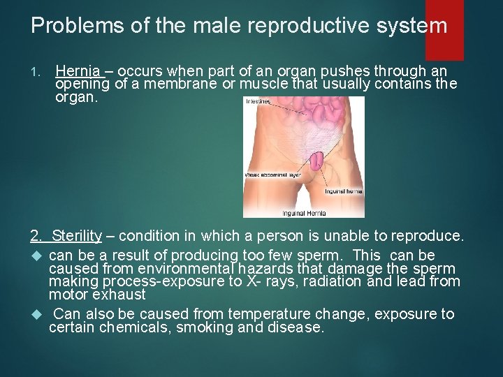 Problems of the male reproductive system 1. Hernia – occurs when part of an