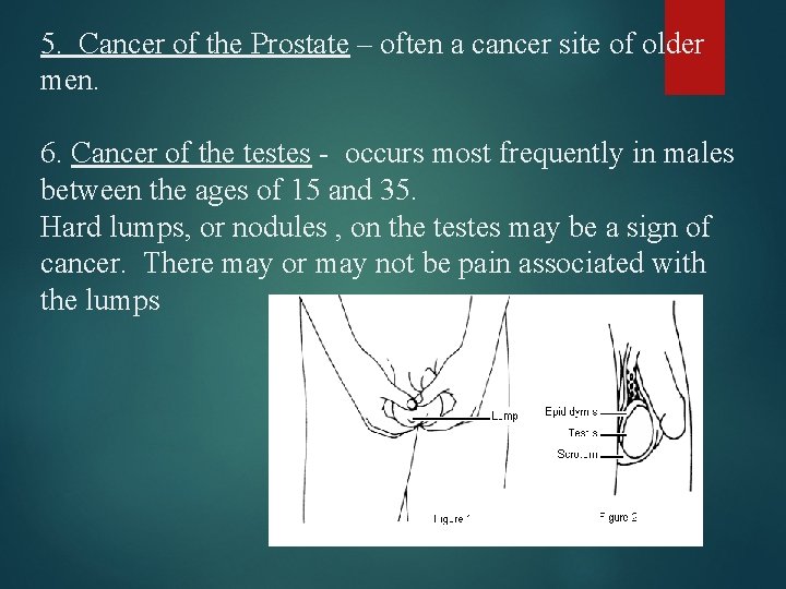 5. Cancer of the Prostate – often a cancer site of older men. 6.