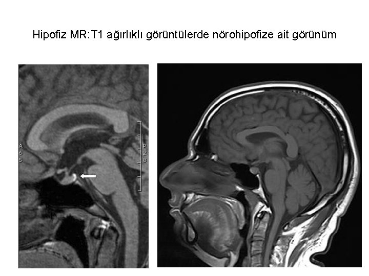 Hipofiz MR: T 1 ağırlıklı görüntülerde nörohipofize ait görünüm Hipofiz MR: T 1 ağırlıklı görüntülerde nörohipofize ait görünüm