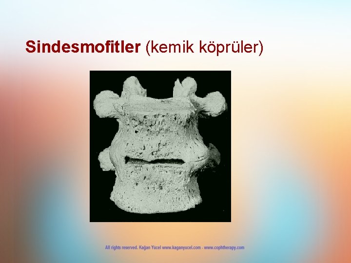 Sindesmofitler (kemik köprüler) 