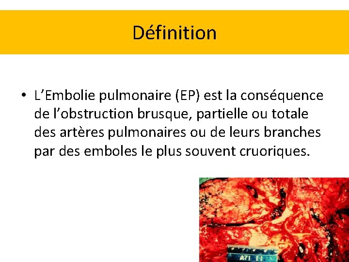Embolie pulmonaire Dr AIT OUKACI Service de pneumologie