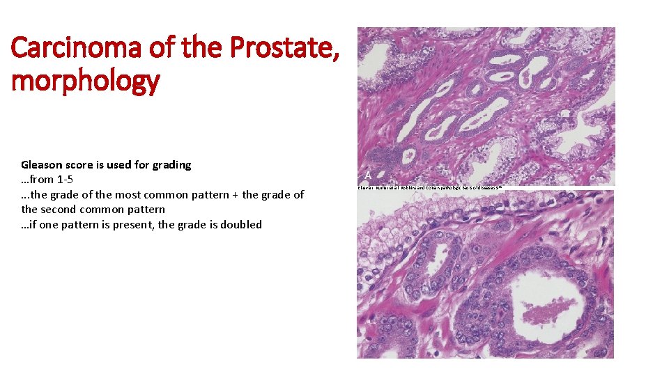 Carcinoma of the Prostate, morphology Gleason score is used for grading …from 1 -5.