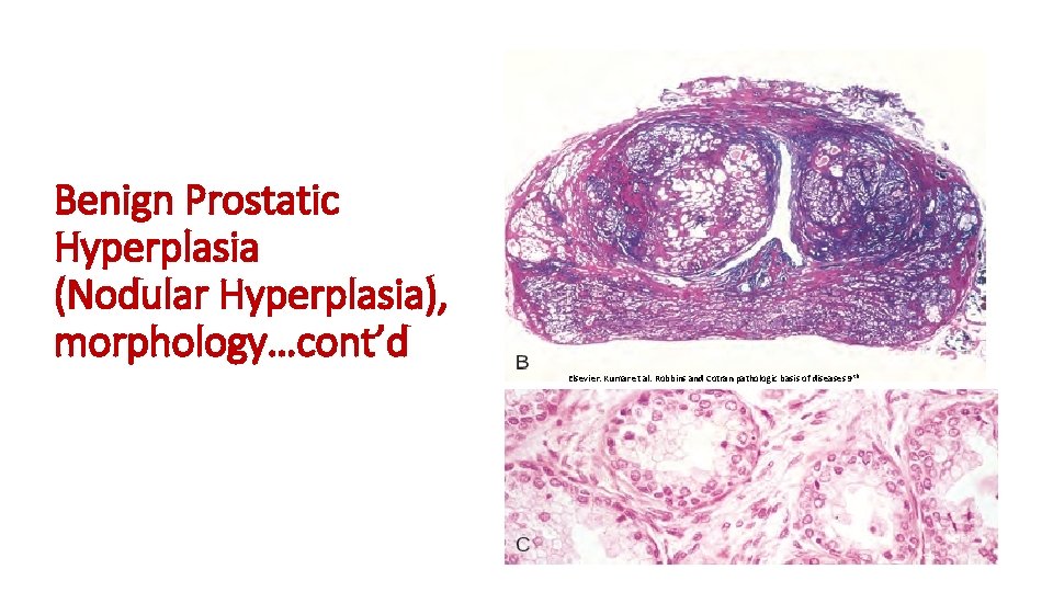 Benign Prostatic Hyperplasia (Nodular Hyperplasia), morphology…cont’d Elsevier. Kumar et al. Robbins and Cotran pathologic