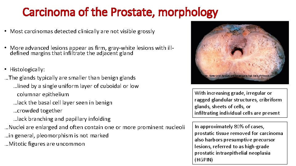 Carcinoma of the Prostate, morphology • Most carcinomas detected clinically are not visible grossly