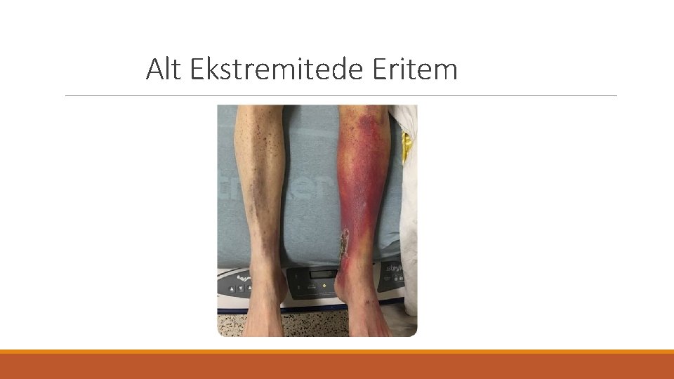 Alt Ekstremitede Eritem 