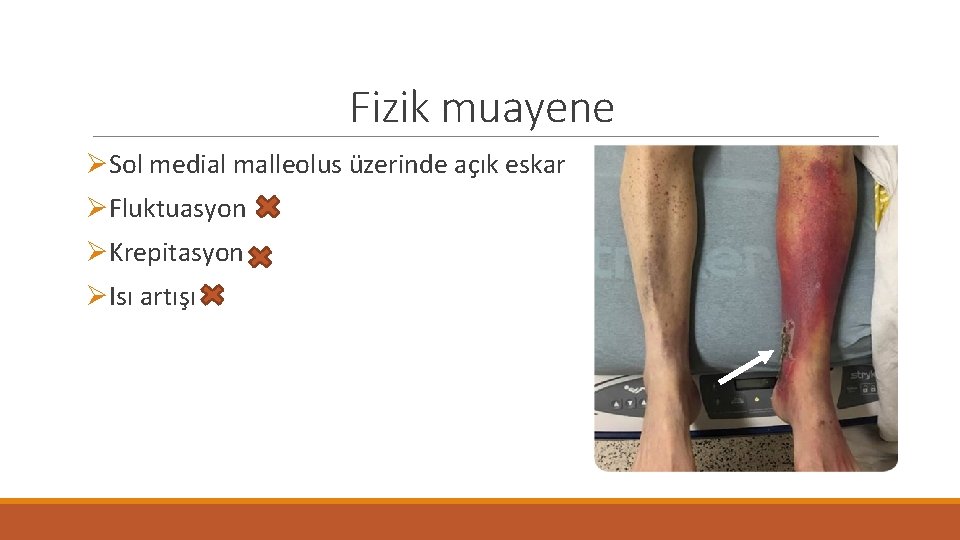 Fizik muayene ØSol medial malleolus üzerinde açık eskar ØFluktuasyon ØKrepitasyon ØIsı artışı 