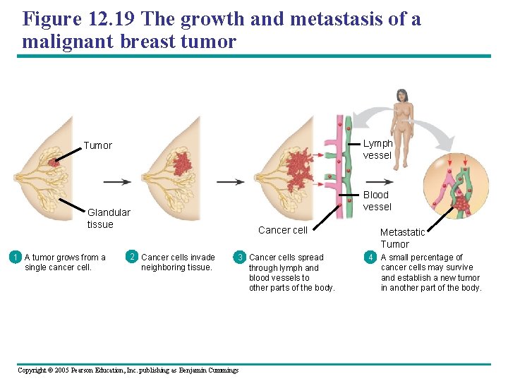 Figure 12. 19 The growth and metastasis of a malignant breast tumor Lymph vessel