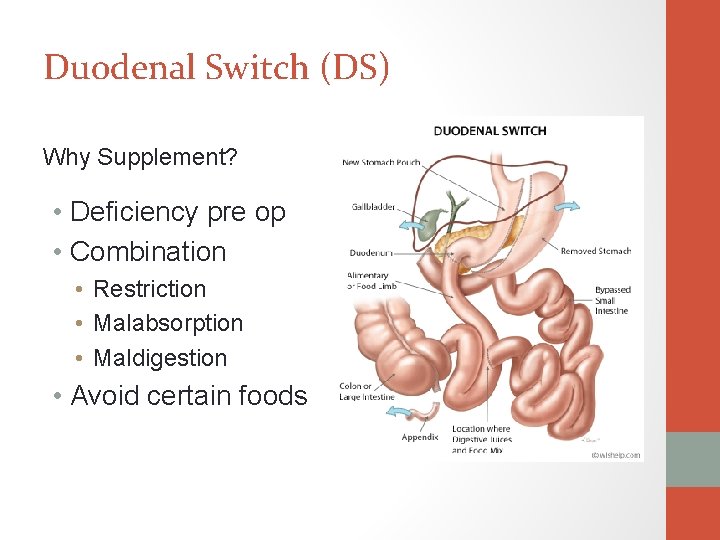 Duodenal Switch (DS) Why Supplement? • Deficiency pre op • Combination • Restriction •