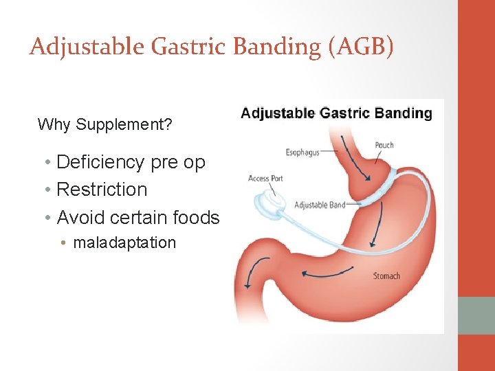 Adjustable Gastric Banding (AGB) Why Supplement? • Deficiency pre op • Restriction • Avoid