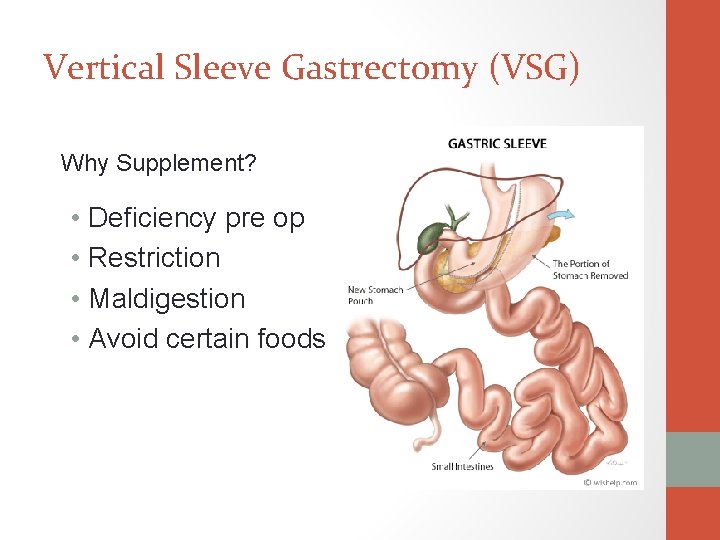 Vertical Sleeve Gastrectomy (VSG) Why Supplement? • Deficiency pre op • Restriction • Maldigestion