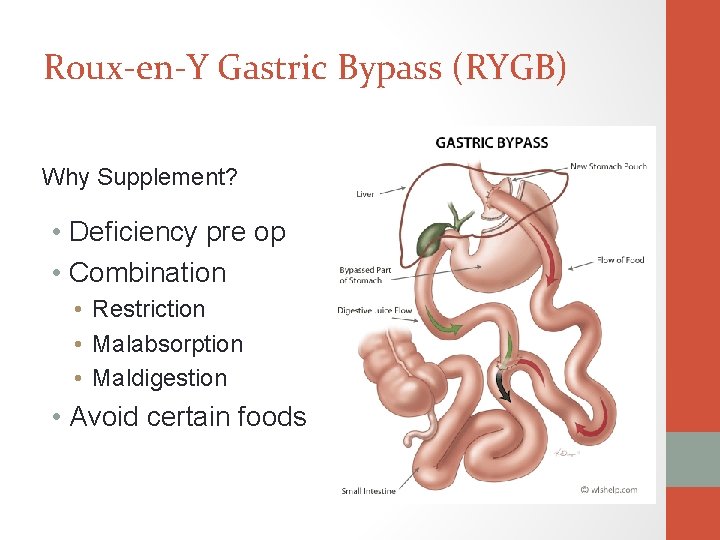 Roux-en-Y Gastric Bypass (RYGB) Why Supplement? • Deficiency pre op • Combination • Restriction