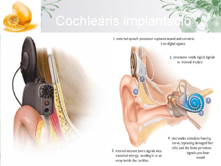 Cochleáris implantáció 