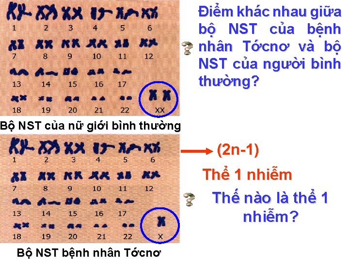 Điểm khác nhau giữa bộ NST của bệnh nhân Tớcnơ và bộ NST của