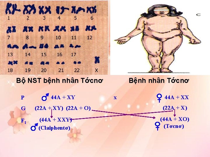 Bệnh nhân Tớcnơ Bộ NST bệnh nhân Tớcnơ P 44 A + XY G