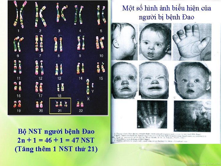 Một số hình ảnh biểu hiện của người bị bệnh Đao Bộ NST người