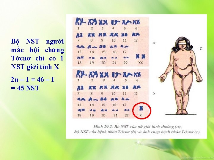 Bộ NST người mắc hội chứng Tớcnơ chỉ có 1 NST giới tính X