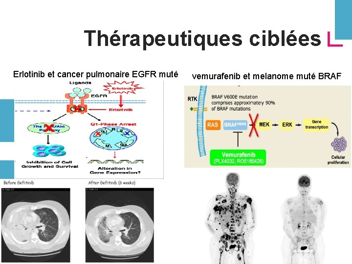 Thérapeutiques ciblées Erlotinib et cancer pulmonaire EGFR muté vemurafenib et melanome muté BRAF 