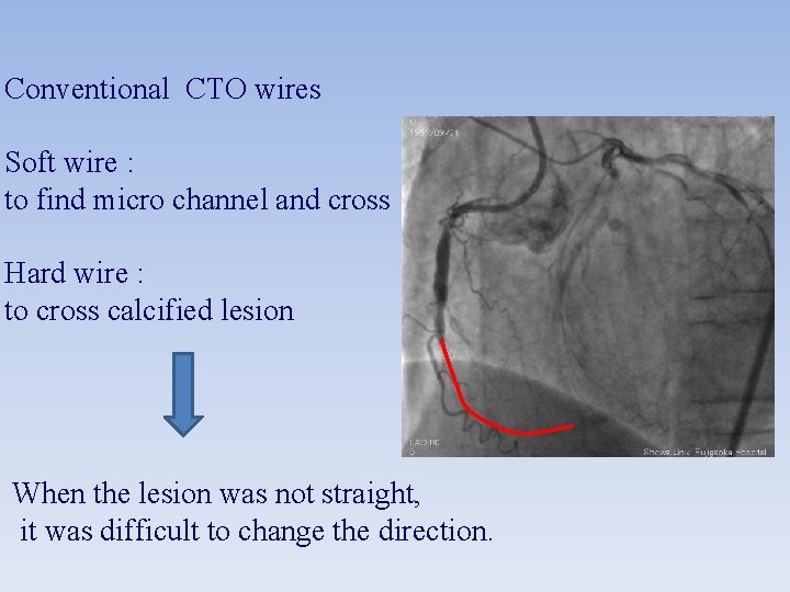 Conventional CTO wires Soft wire : to find micro channel and cross Hard wire