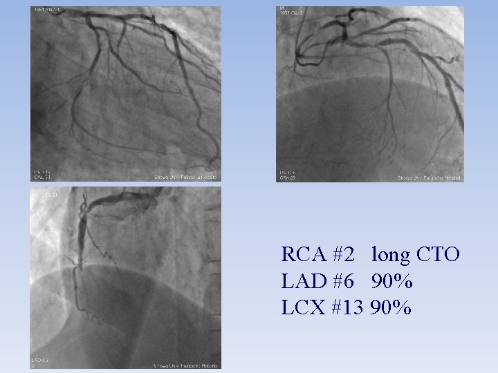 RCA #2 long CTO LAD #6 90% LCX #13 90% 